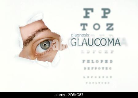 Woman`s eye looking trough teared hole in paper, eye test and word Glaucoma on right. Eye disease concept template. Isolated white background. Stock Photo